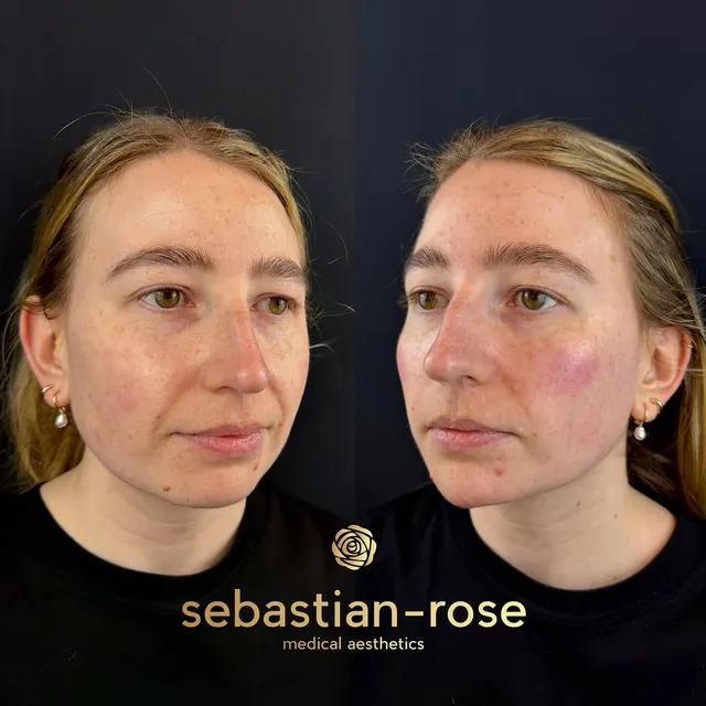 Before and after a subtle 2ml dermal filler treatment
