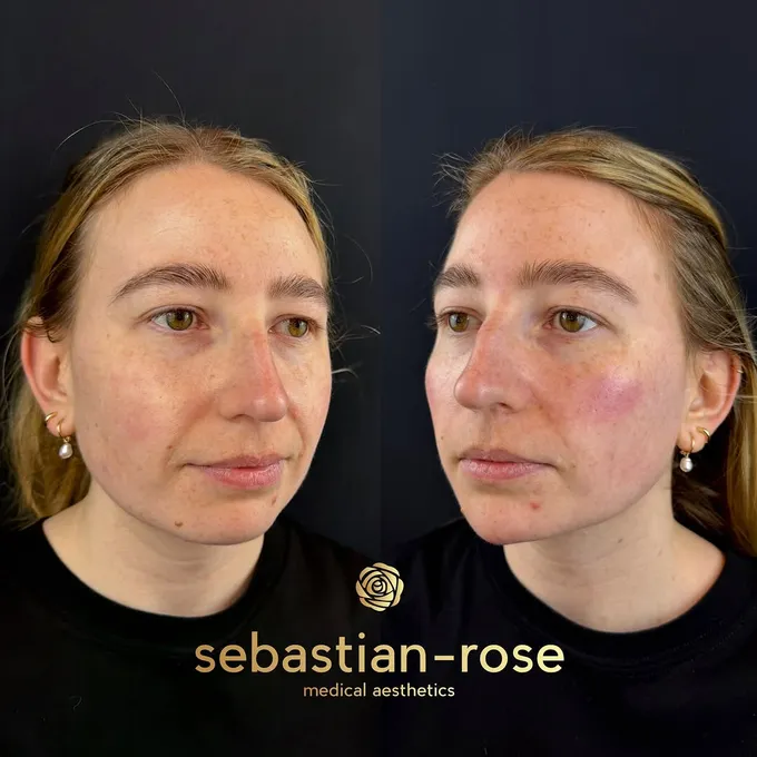 Before and after a subtle full-face result using only 2ml of dermal filler