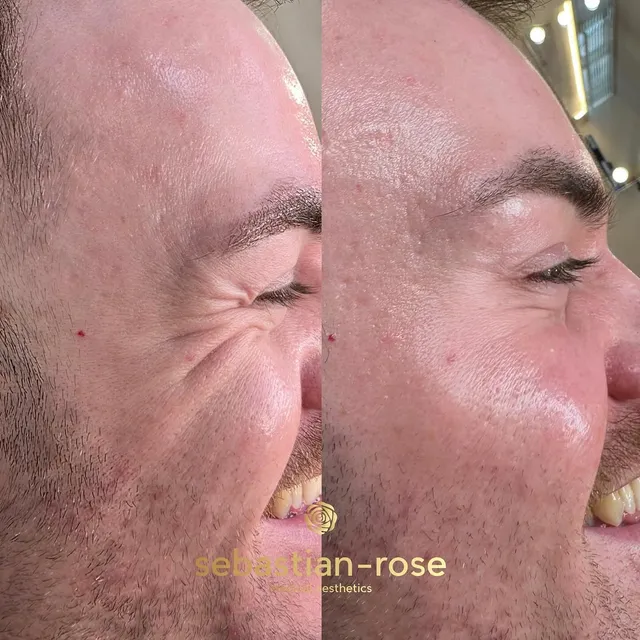 Before and after anti-wrinkle treatment softening lines around the eyes