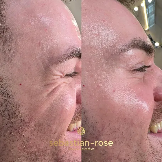 Anti-wrinkle treatment result around the eyes