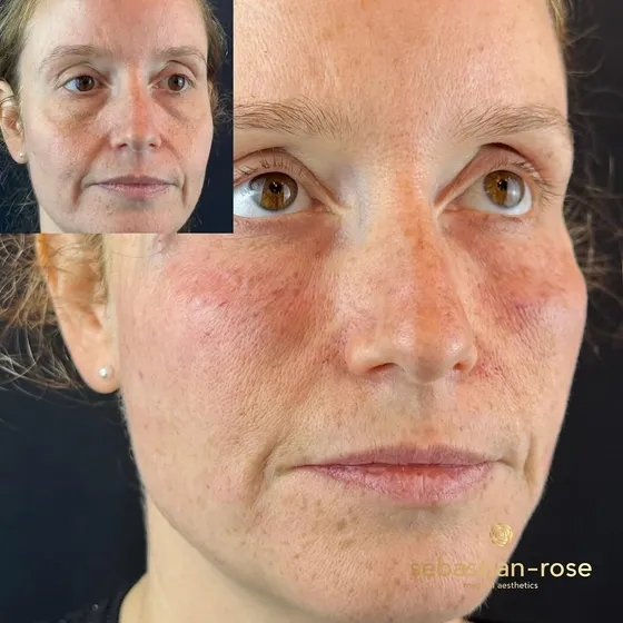 Skin rejuvenation result
