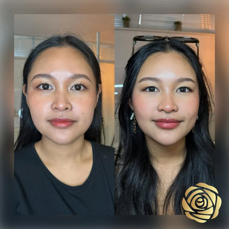 A jawline slimming result, showing a softened, natural V-shape