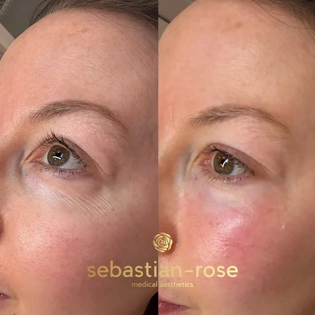 Before and after under-eye treatment with Juvelook, smoothing the under-eye area