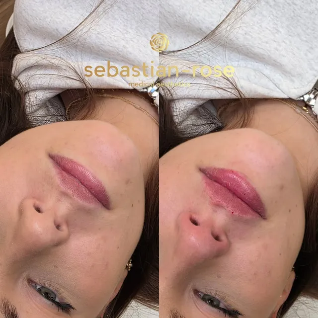Before and after a subtle lip enhancement focused on shape and hydration