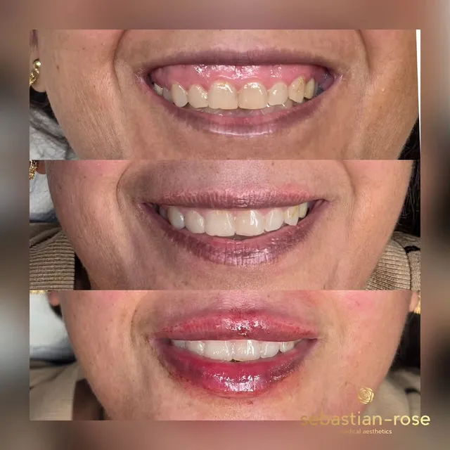 Before and after lip filler balancing the smile and lip shape