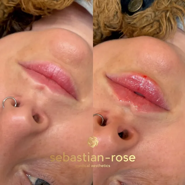 Before and immediately after lip filler shaping