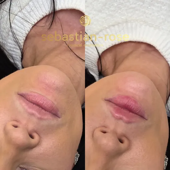 Natural lip filler result
