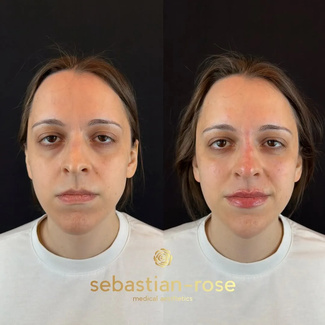 A patient’s subtle full-face refresh at Sebastian-Rose Medical Aesthetics