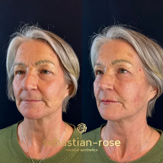 Full-face rejuvenation result