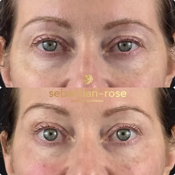 Under-eye treatment result