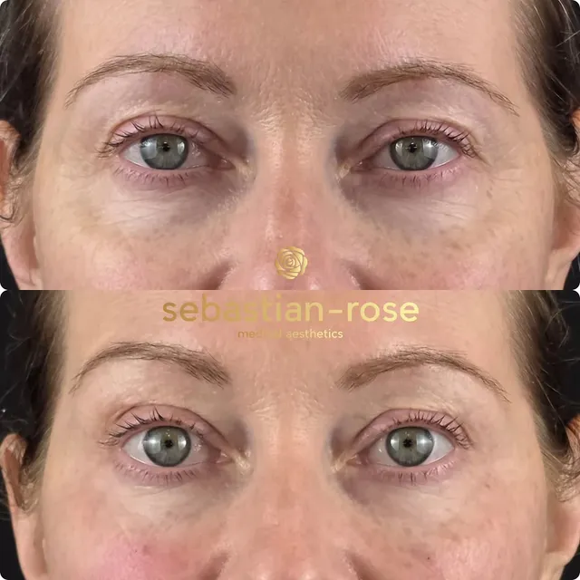 Before and after under-eye and orbital rim treatment, brightening tired eyes